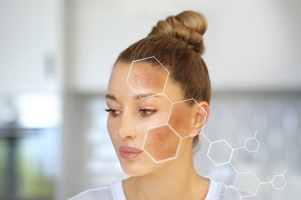 Melasma: What It Is, Causes, Treatments, and How to Lighten