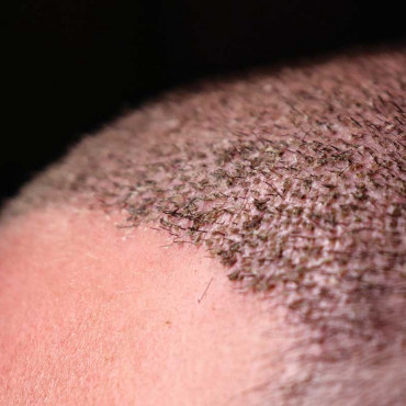 Hair Transplant em Kelowna / BC