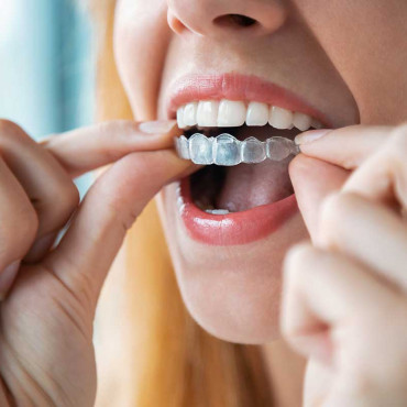 Invisalign em Kelowna / BC