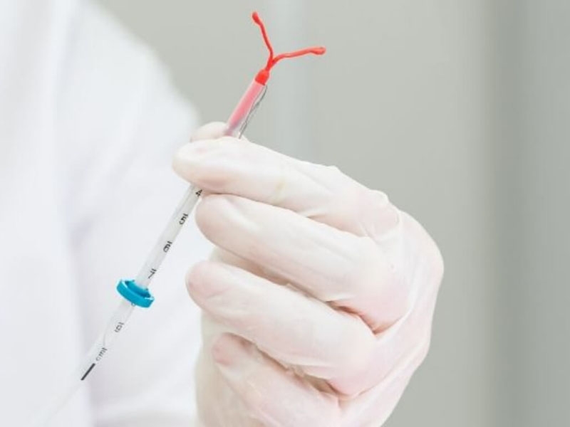 IUD removal