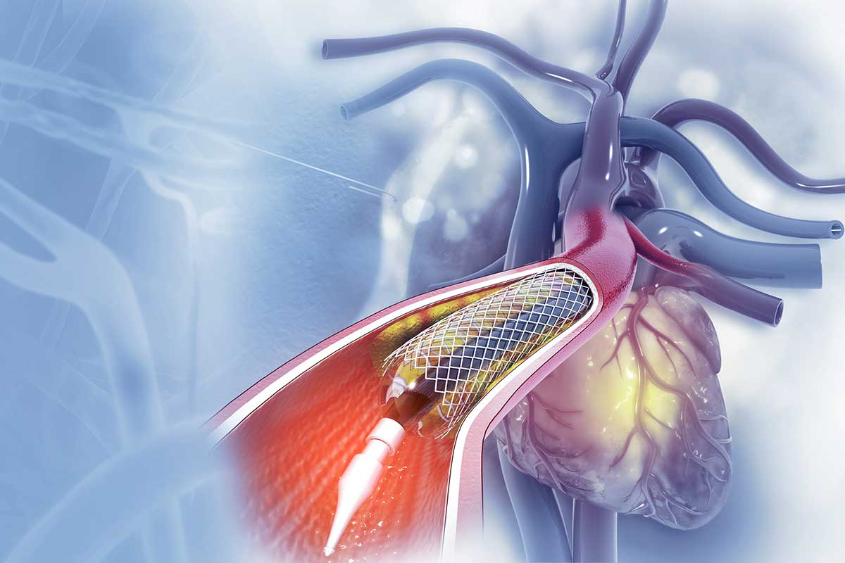 Angioplasty