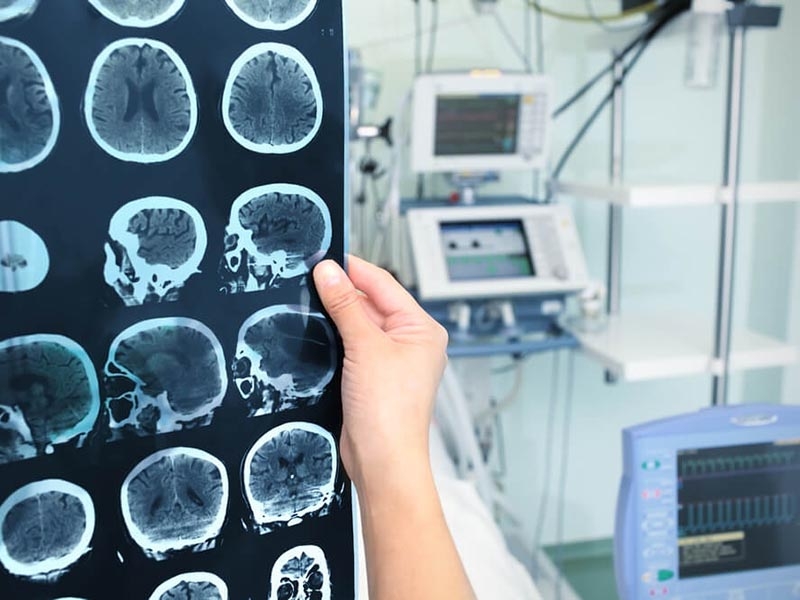 Electroencephalogram
